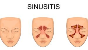 chronic sinusitis